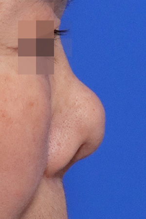 Before surgery