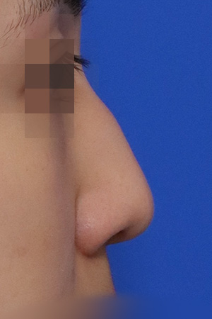 Before surgery