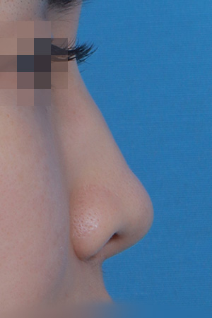Before surgery
