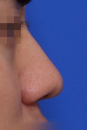 Before surgery