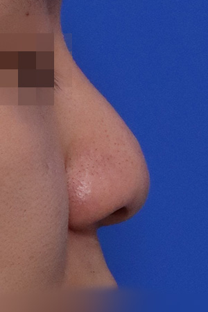 Before surgery