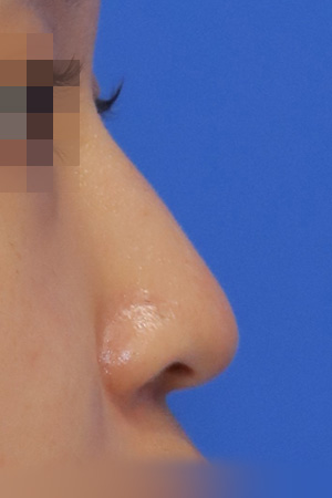 Before surgery