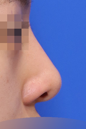Before surgery