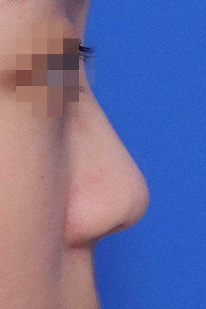 Before surgery