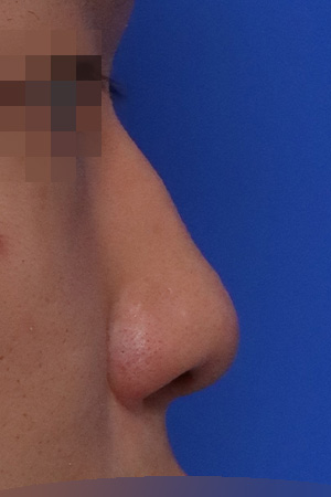 Before surgery