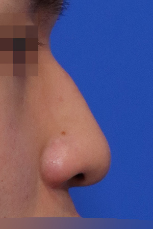 Before surgery