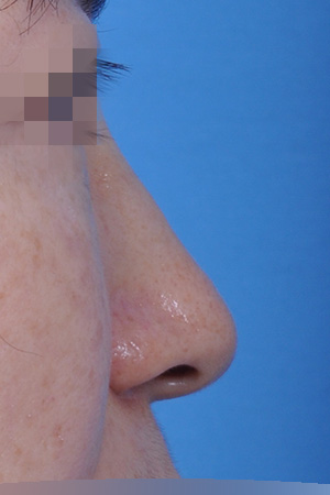 Before surgery
