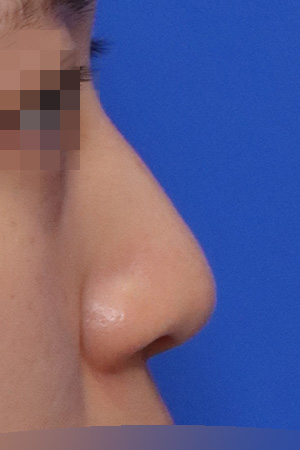 Before surgery