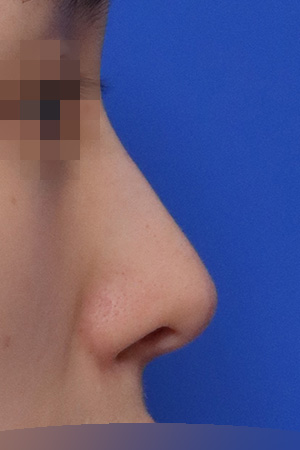 Before surgery