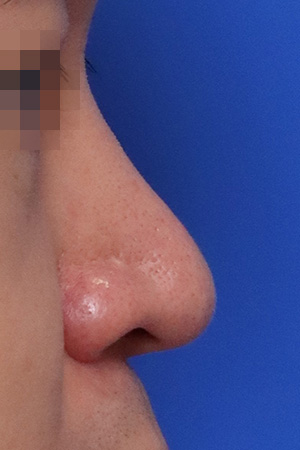 Before surgery