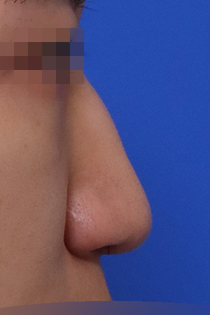 Before surgery