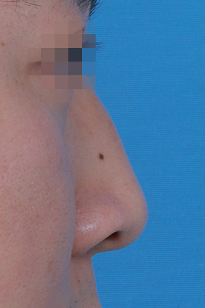 Before surgery