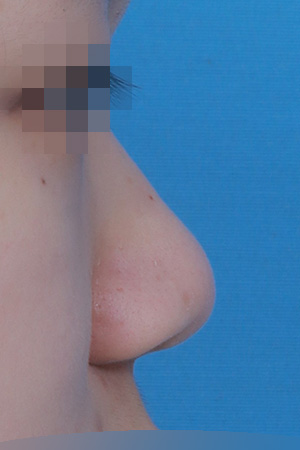 Before surgery