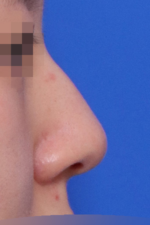 Before surgery