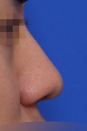 Before surgery