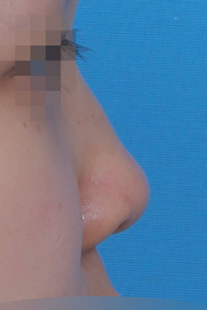 Before surgery