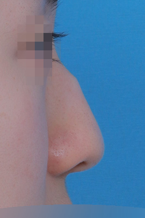 Before surgery