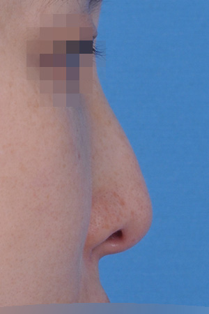 Before surgery