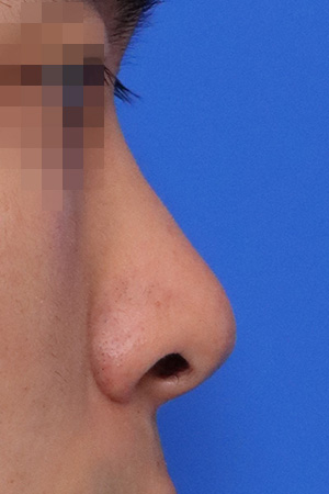 Before surgery