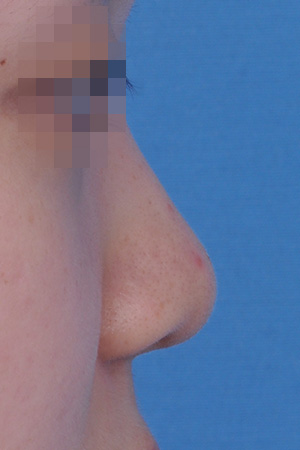 Before surgery