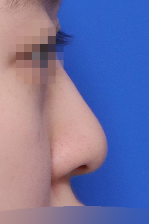 Before surgery
