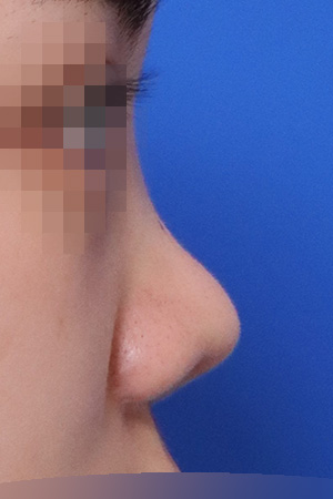 Before surgery