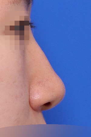 Before surgery