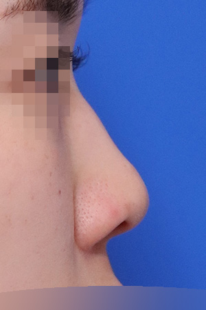Before surgery