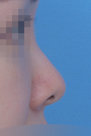 Before surgery