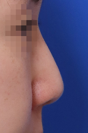 Before surgery