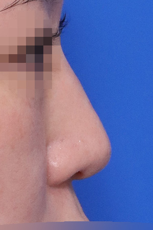 Before surgery