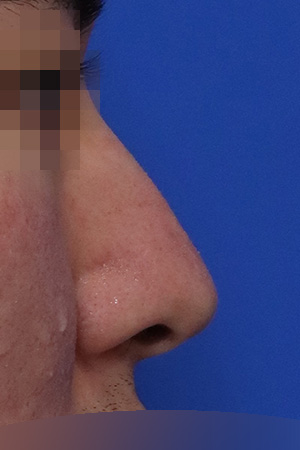 Before surgery