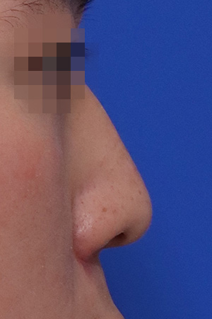 Before surgery