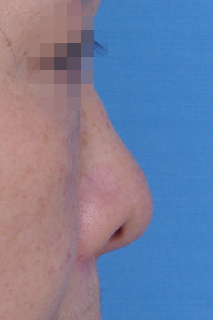 Before surgery