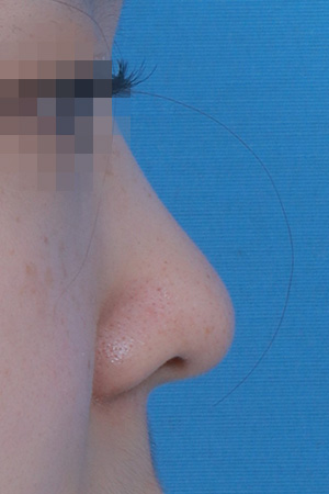 Before surgery