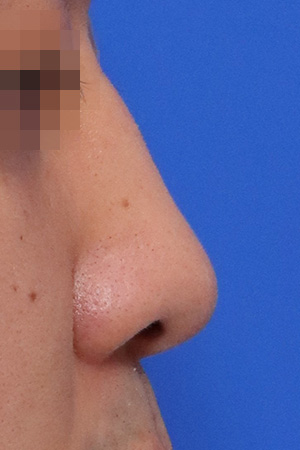 Before surgery