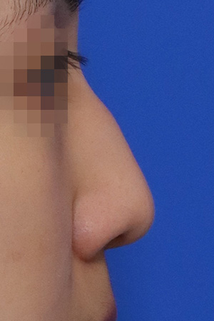 Before surgery
