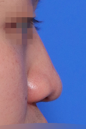 Before surgery