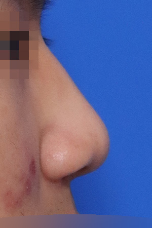 Before surgery