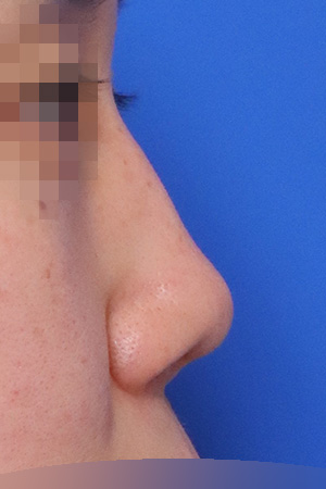 Before surgery