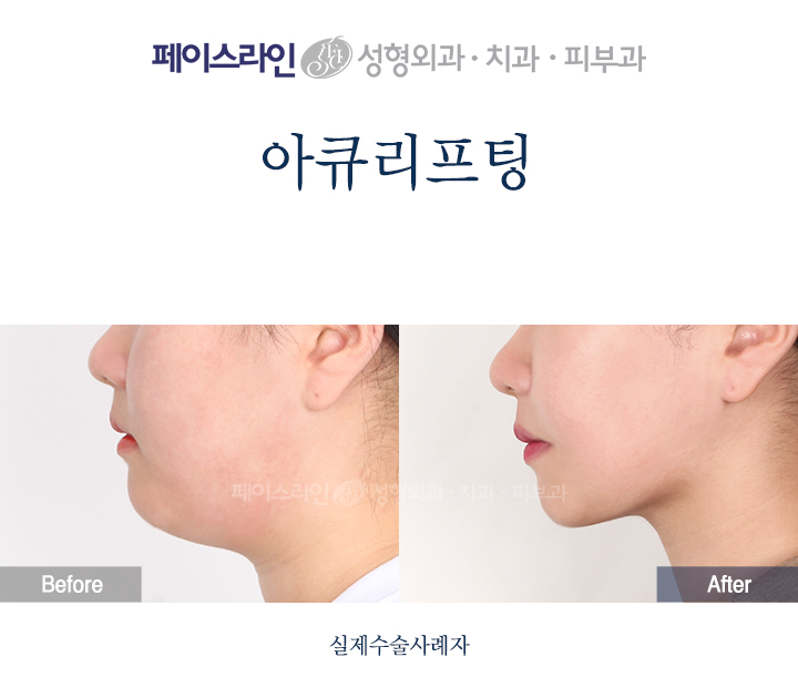 Profile view; before on the left and after on the right.