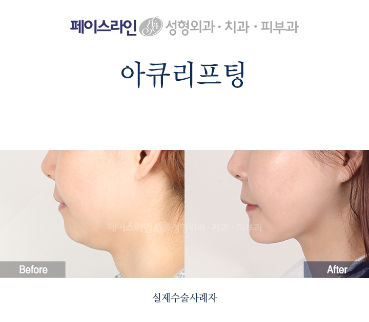 Profile view; before on the left and after on the right.