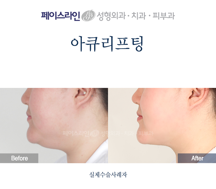Profile view; before on the left and after on the right.