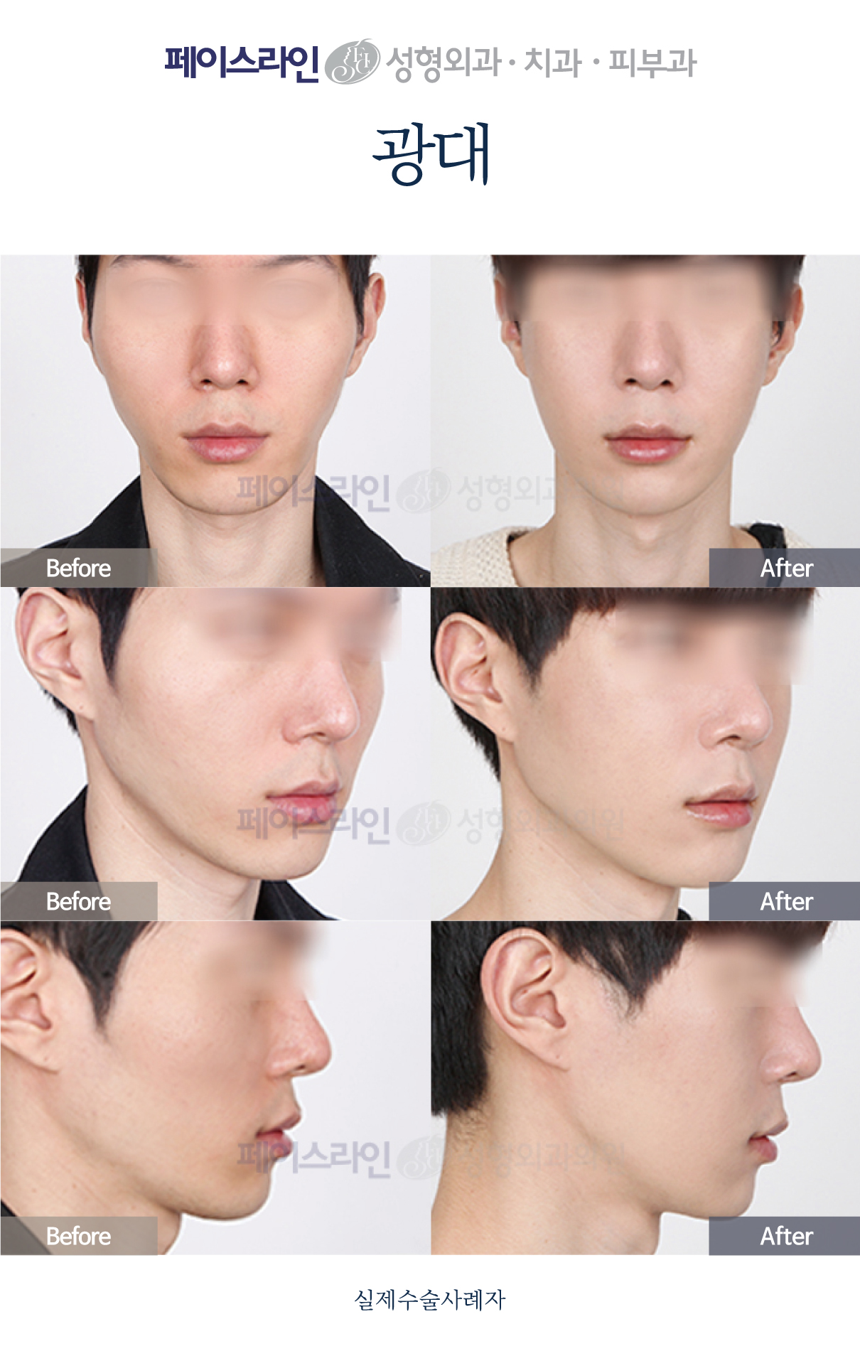 Front, angled and profile views; before on the left and after on the right.