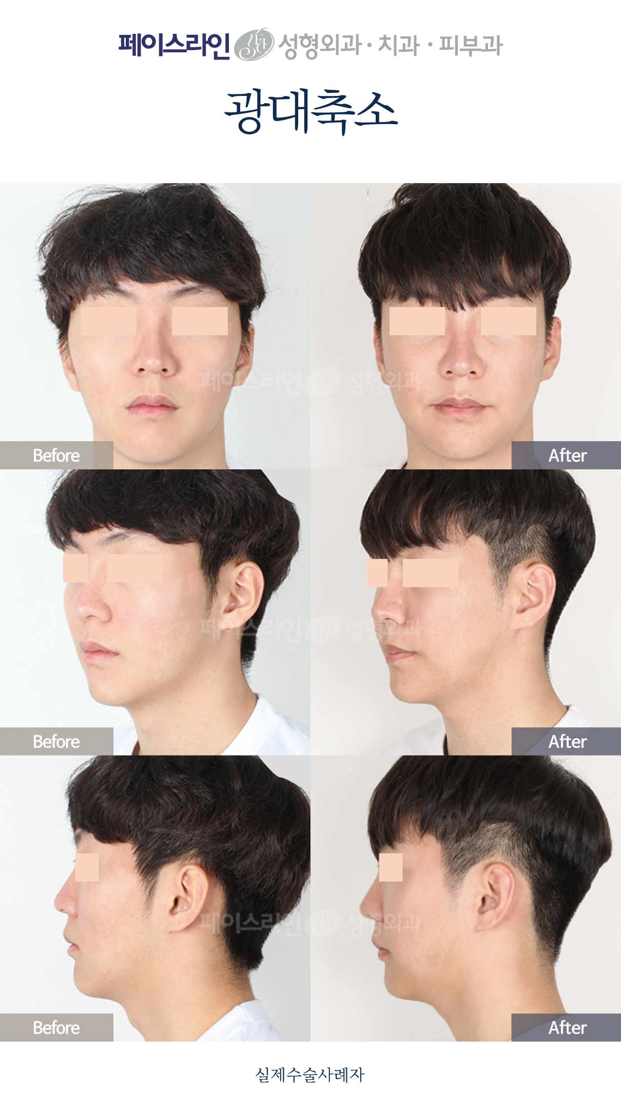Front, angled and profile views; before on the left and after on the right.