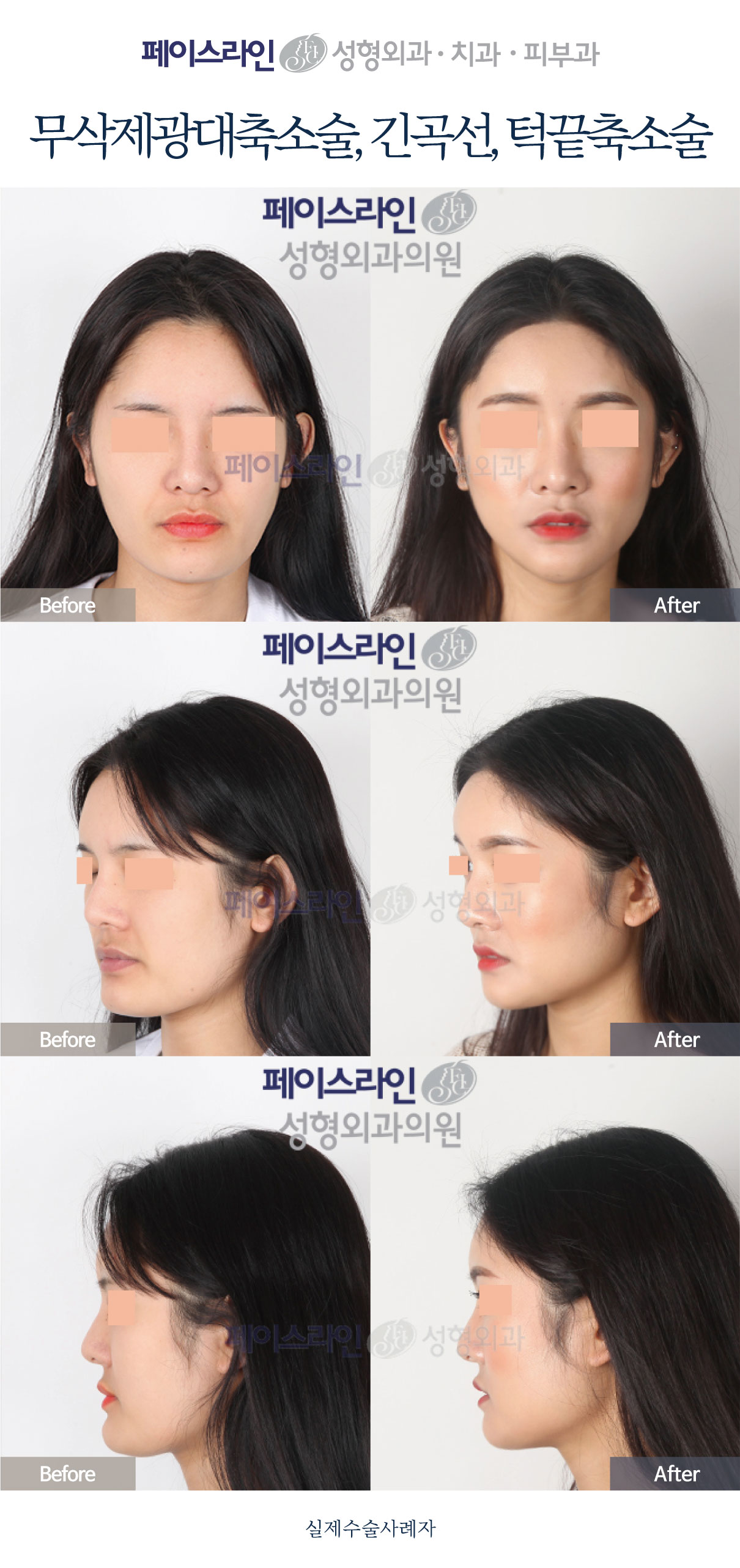 Front, angled and profile views; before on the left and after on the right.