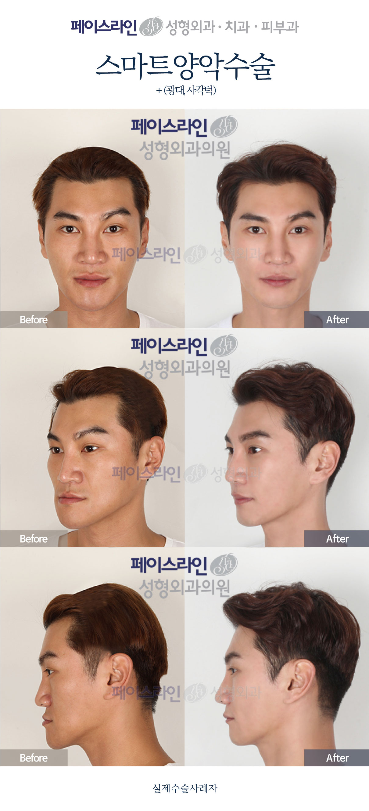 Front, angled and profile views; before on the left and after on the right.