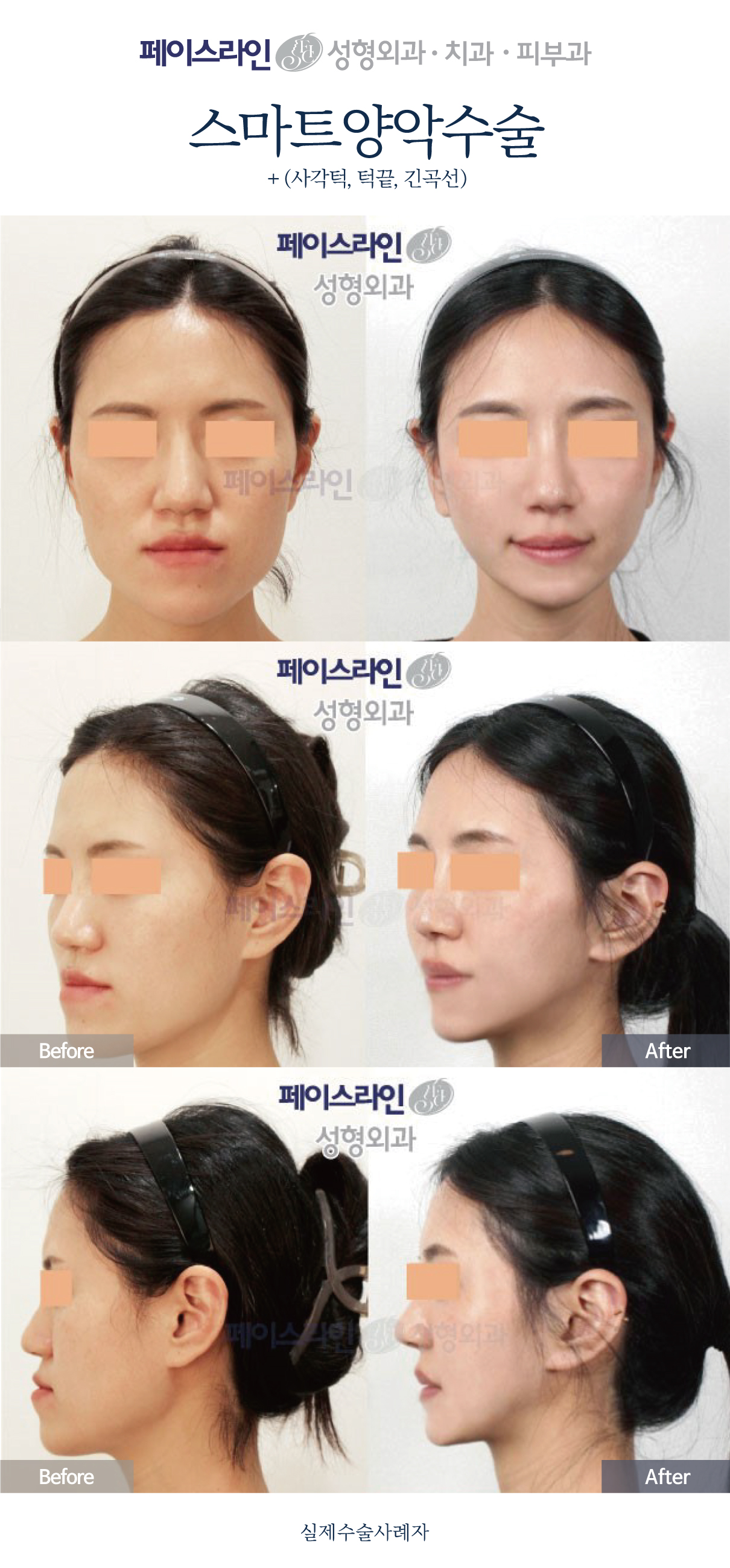 Front, angled and profile views; before on the left and after on the right.