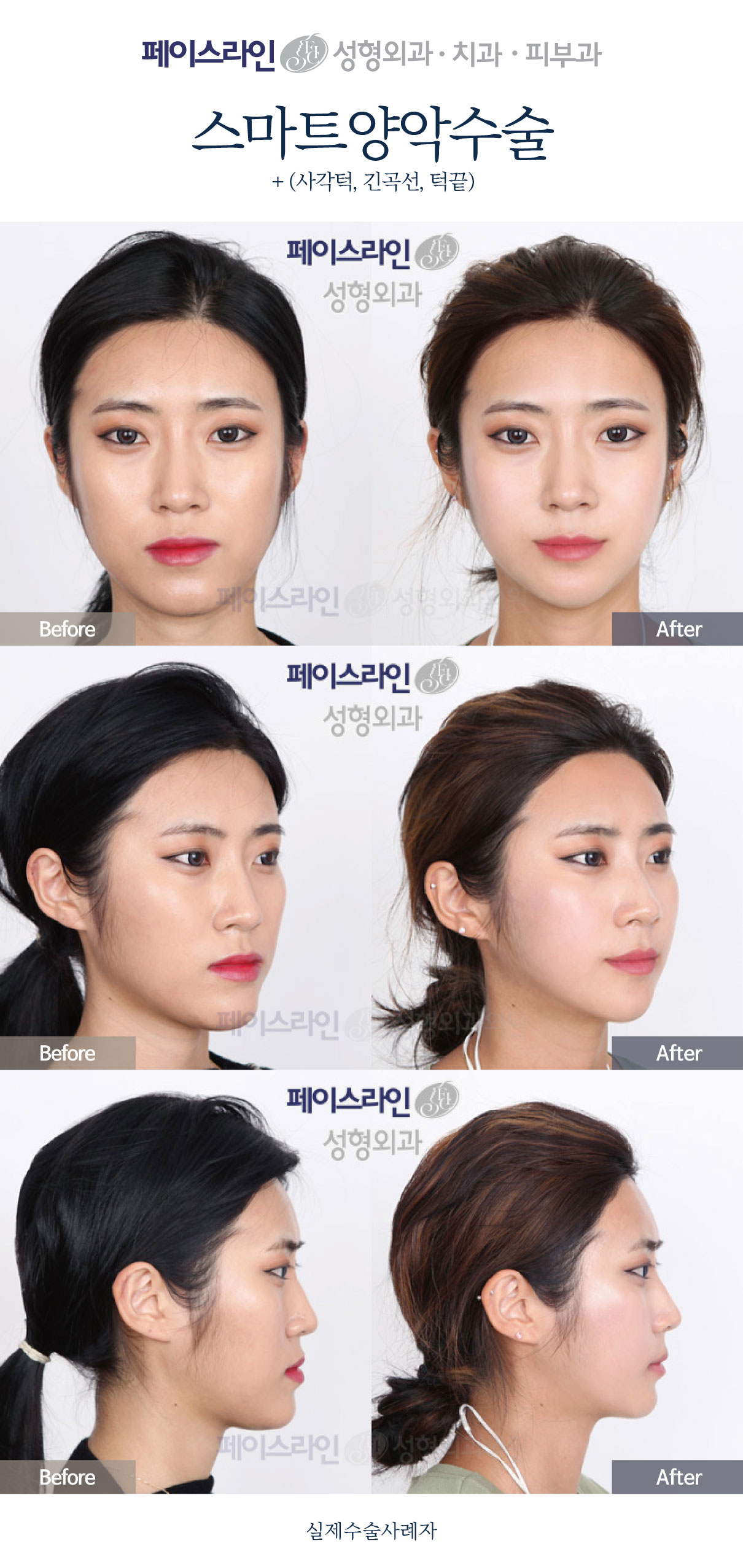 Front, angled and profile views; before on the left and after on the right.