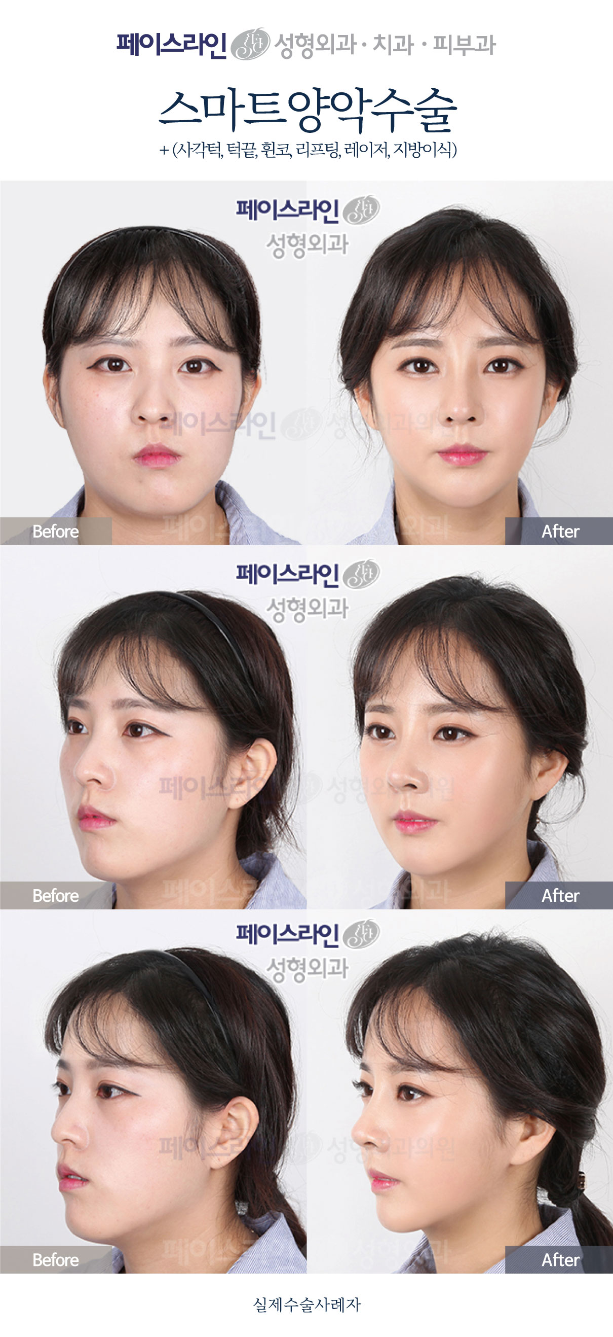 Front, angled and profile views; before on the left and after on the right.
